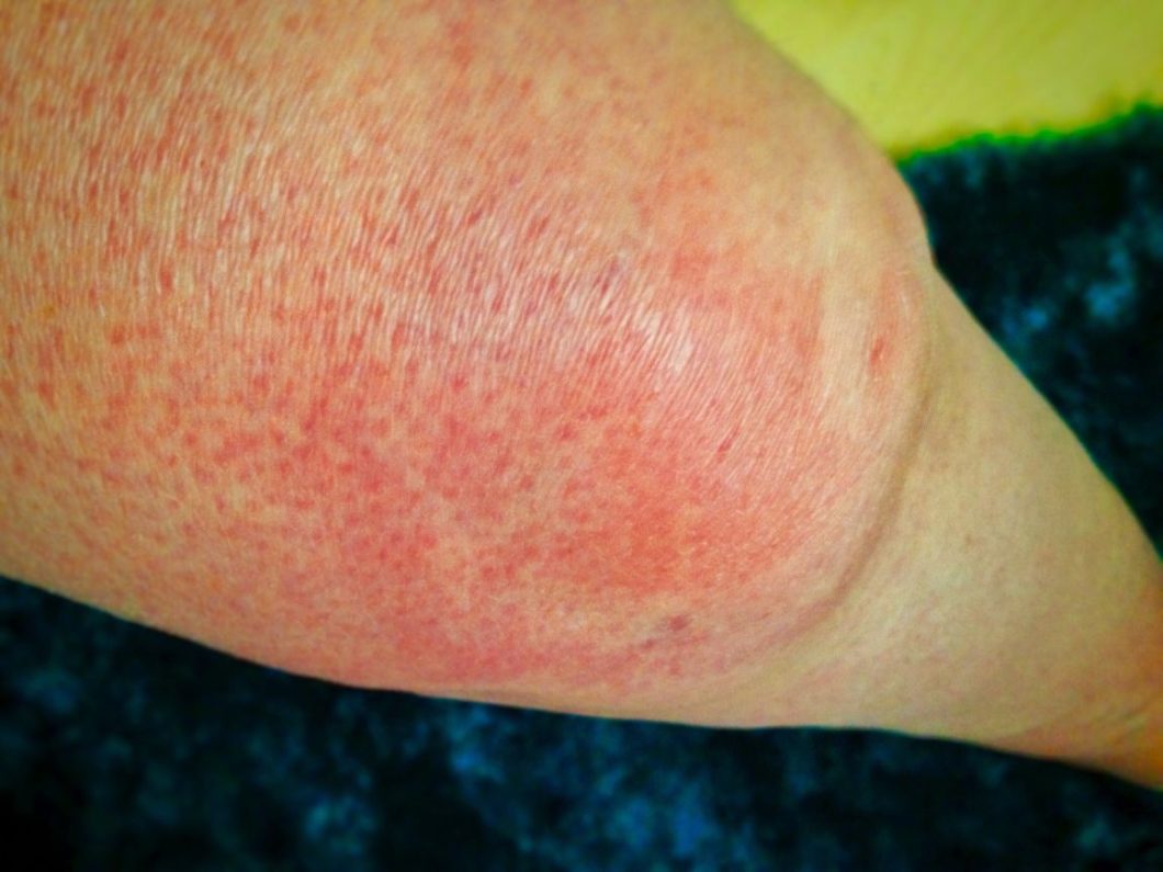 Allergies-rash-swollen-knee-in-pic-hives-is-an-itchy-and-painful-rash 