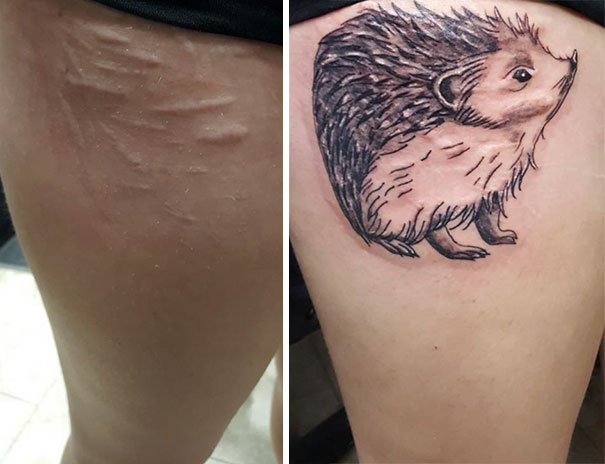 Tattoo Removal Roanoke VA